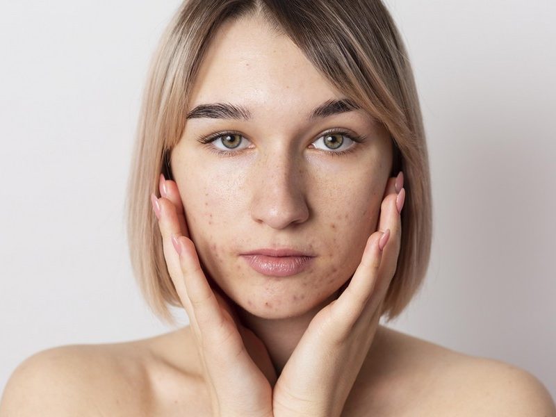 Que faire contre l’acné sur le visage ?